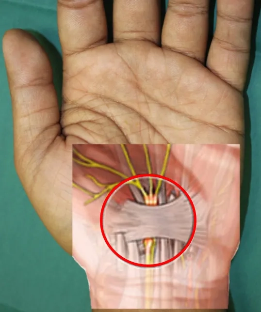 Before and after carpal tunnel surgery