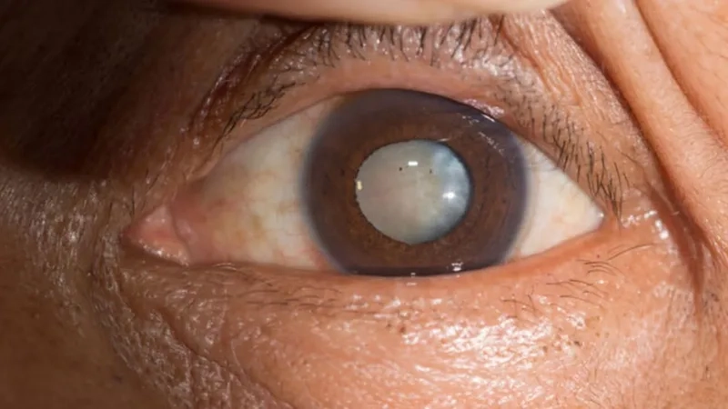Understanding the factors of cataract surgery cost
