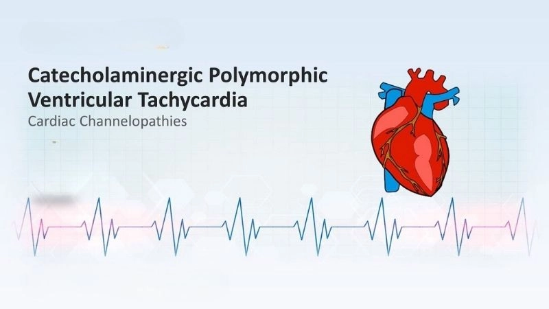 CPVT Diagnosis confirms dangerous arrhythmia condition