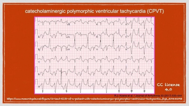 CPVT In Children reveals early warning signals