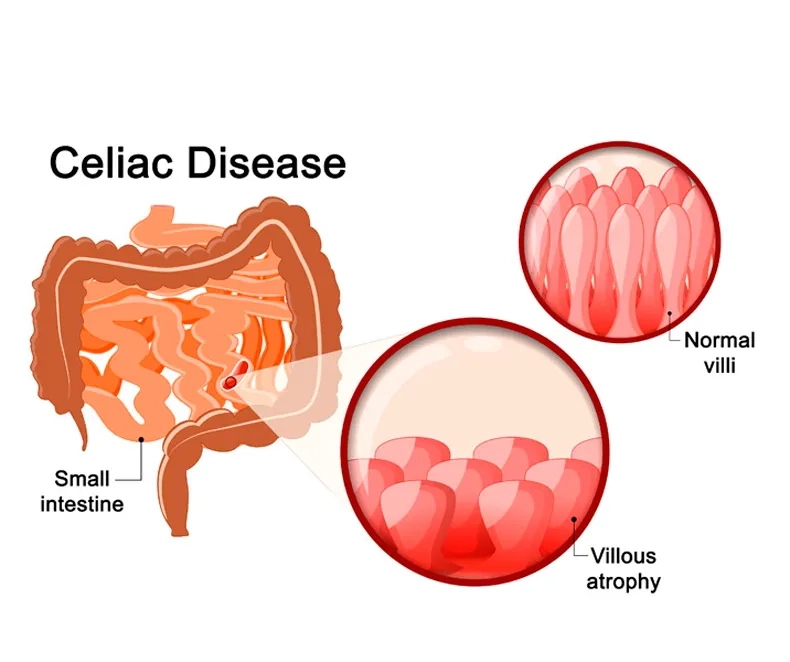 The wide range of celiac disease symptoms
