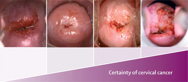 Early cervical cancer symptoms awareness