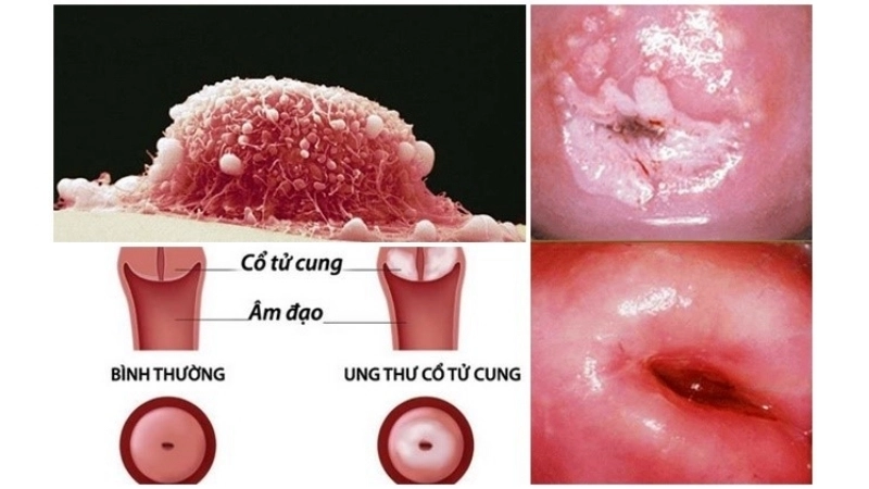 Pap smear helps detect Cervical Cancer early