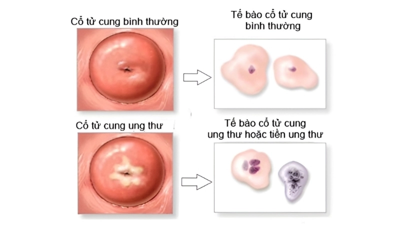 Breast cancer and Cervical Cancer need screening