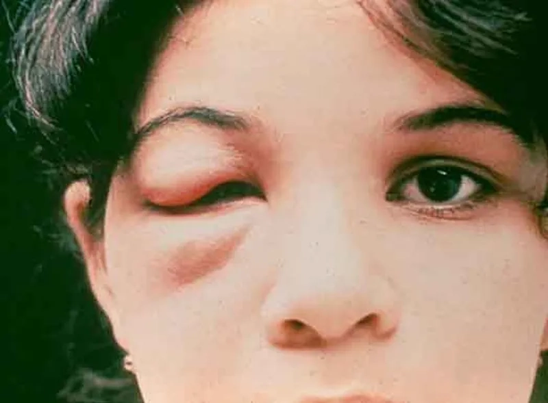 Effective Chagas disease treatment can prevent complications