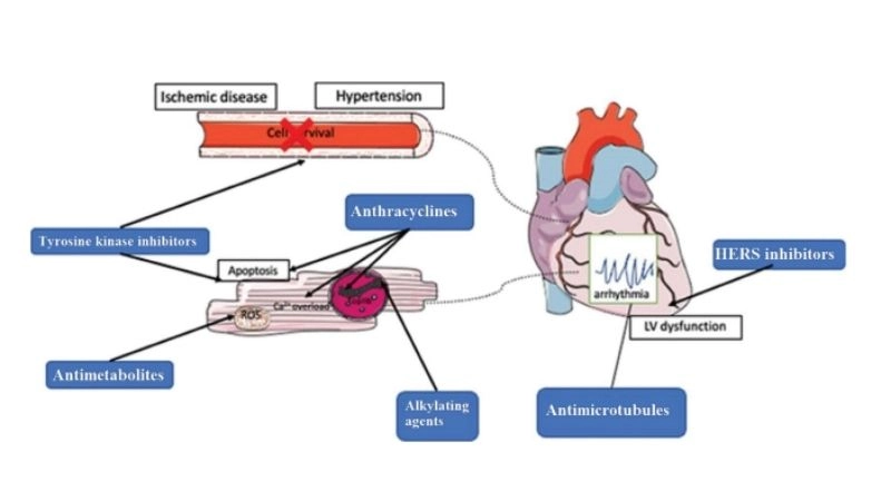 Chemotherapy induced cardiomyopathy treatment protecting heart health
