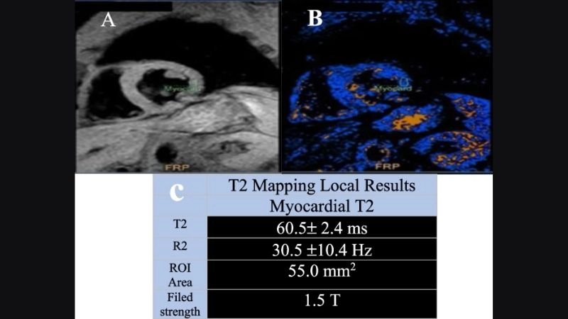 Chemotherapy related cardiac dysfunction tracking heart health
