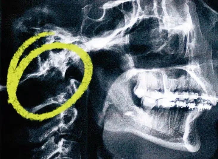 A diagram of a Chiari malformation surgery