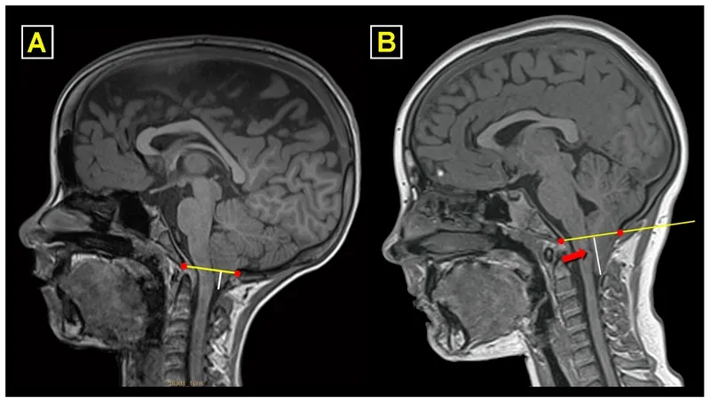 A visual guide to Chiari malformation symptoms