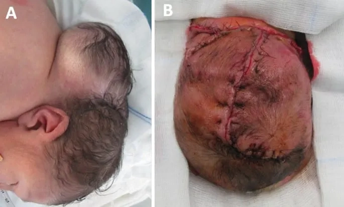 An MRI scan showing what is Chiari malformation
