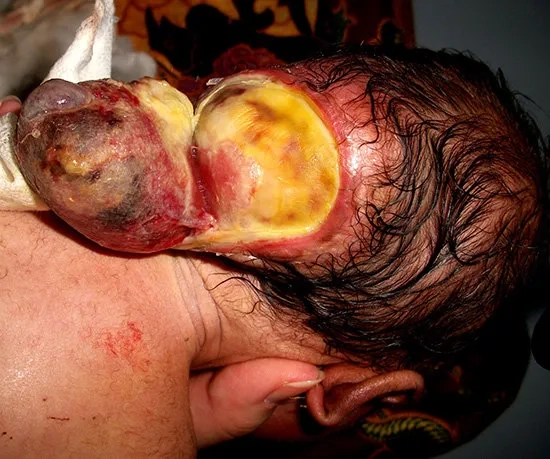 An overview of Chiari malformation treatment