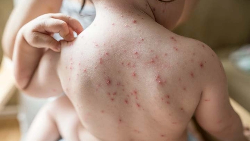 See what do chickenpox look like up close