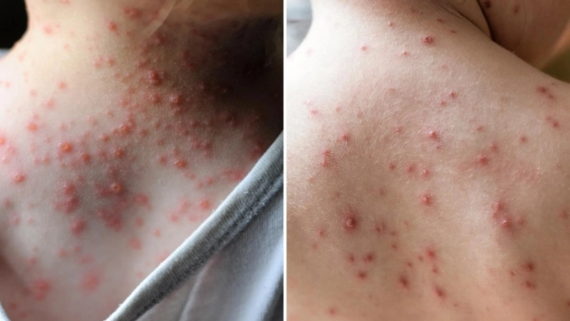  Protecting a newborn from chickenpox risks