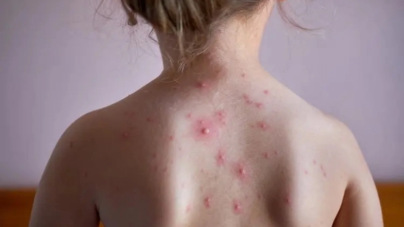 A collection of chickenpox images for reference