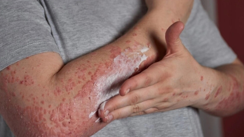 The chickenpox incubation period explained