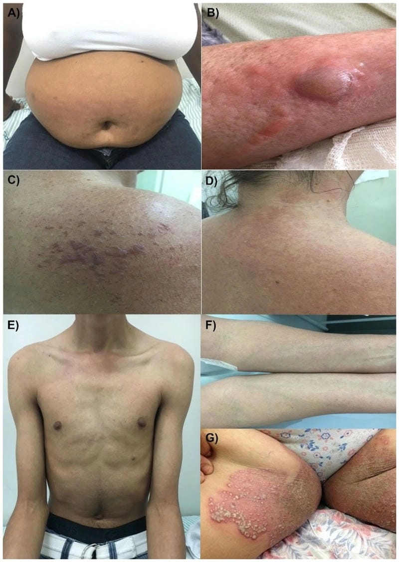 Understanding the potential long-term effects of Chikungunya