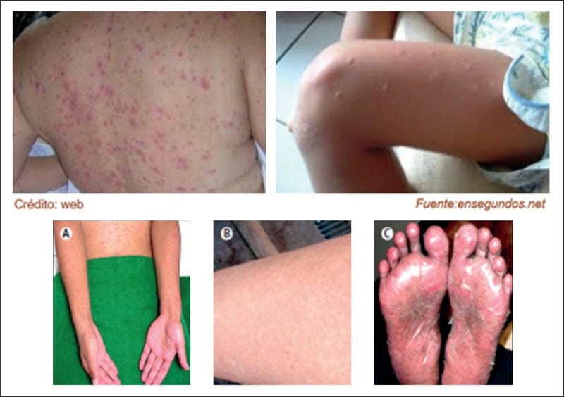 A visual example of a rash caused by Chikungunya virus