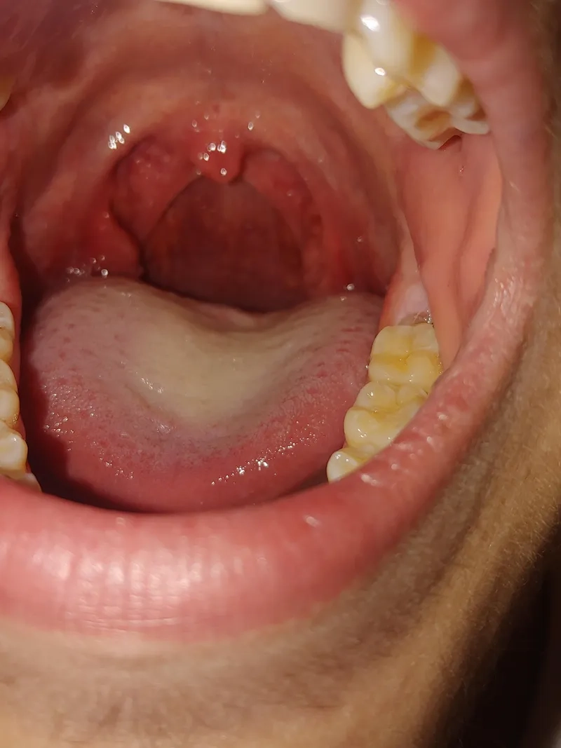 Untreated chlamydia long term effects on reproductive health