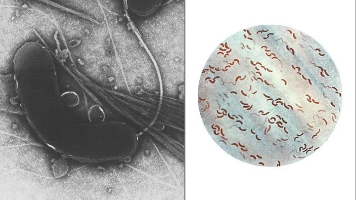 A patient displaying severe cholera symptoms