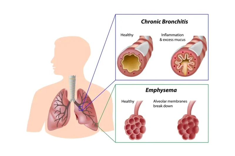Acute vs chronic bronchitis comparison chart