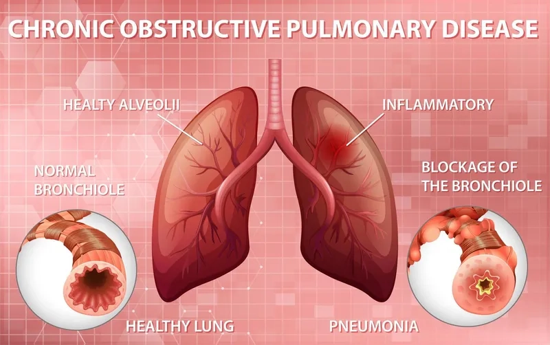 Copd symptoms and common respiratory indicators