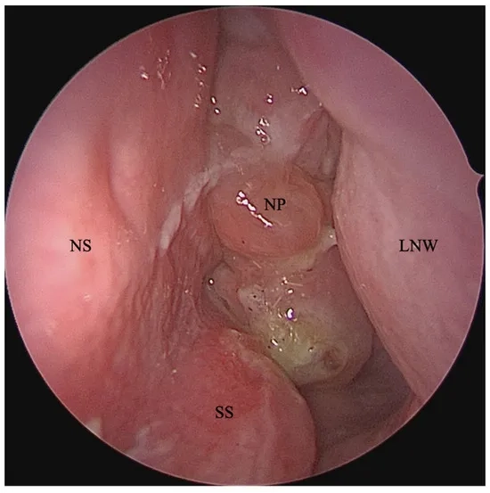 Endoscopic image showing nasal polyps