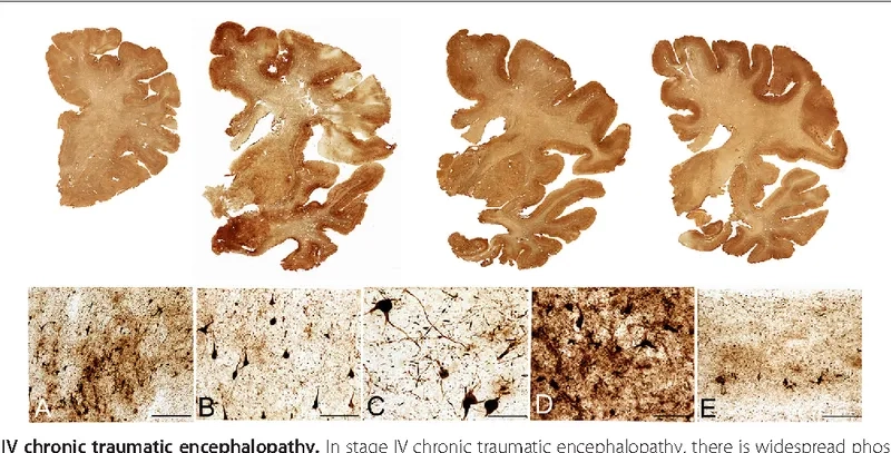 The complex process of a post-mortem CTE diagnosis