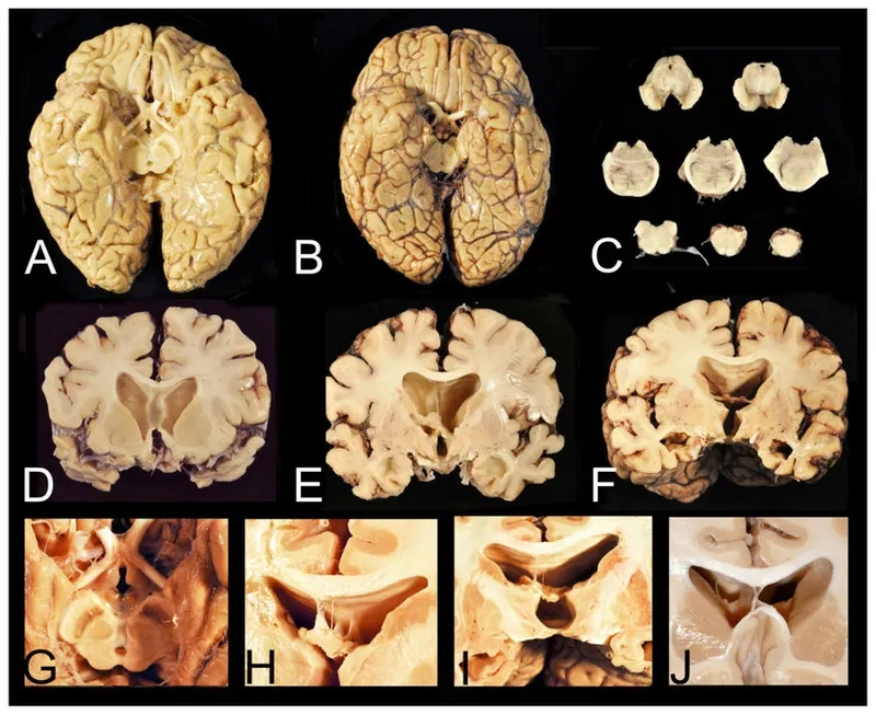 The challenges surrounding a definitive CTE diagnosis in the living