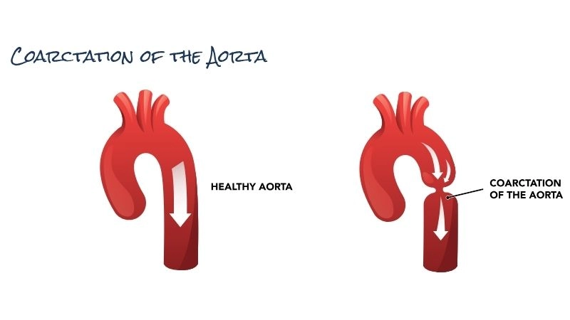 Coarctation of the aorta symptoms warning signs of narrowed vessel