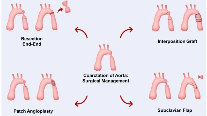 Coarctation of the aorta complications dangers if left untreated