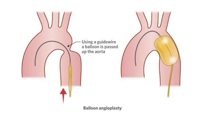 Coarctation of the aorta vs aortic stenosis key differences
