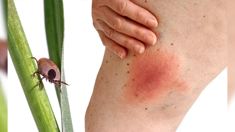 Colorado Tick Fever facts for health