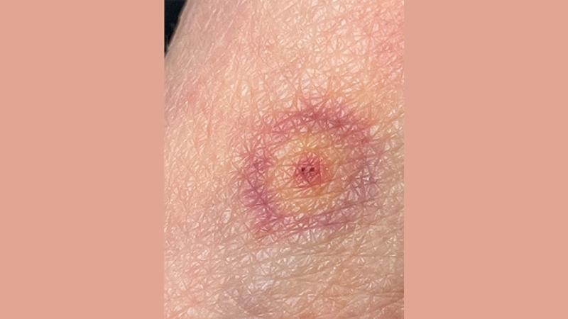 Colorado Tick Fever with muscle pain signs