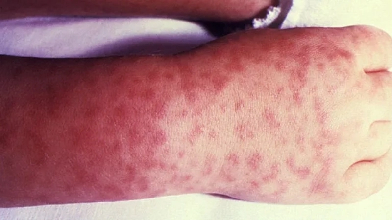 Colorado Tick Fever linked with CTF virus