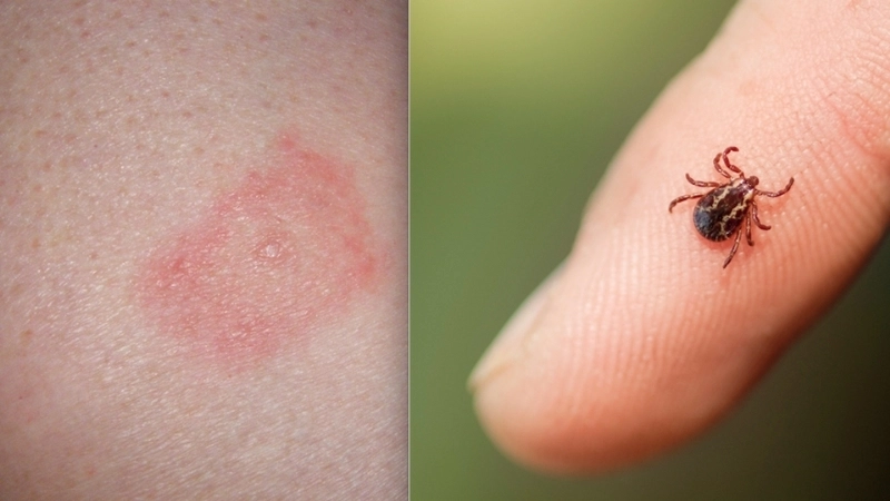 Colorado Tick Fever from Dermacentor andersoni