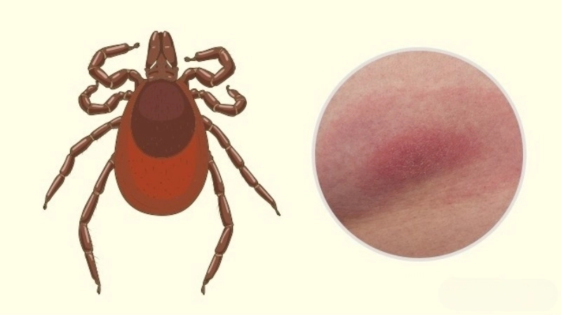 Colorado Tick Fever Rocky Mountain wood tick