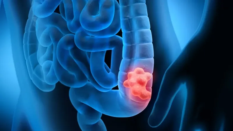 Understanding the colorectal cancer survival rate