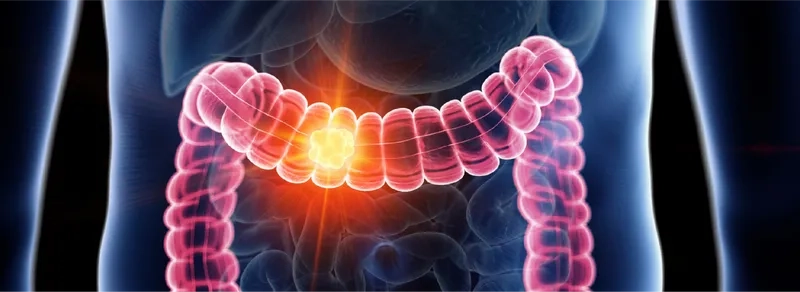 Key bowel cancer symptoms to be aware of