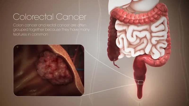 A medical explanation of what is colorectal cancer