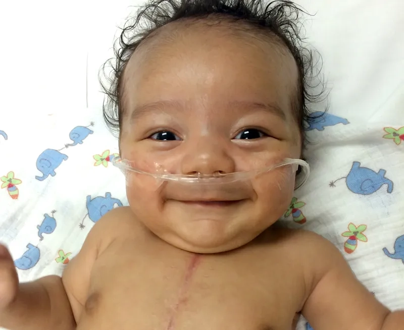 Anatomy of an atrial septal defect (ASD)