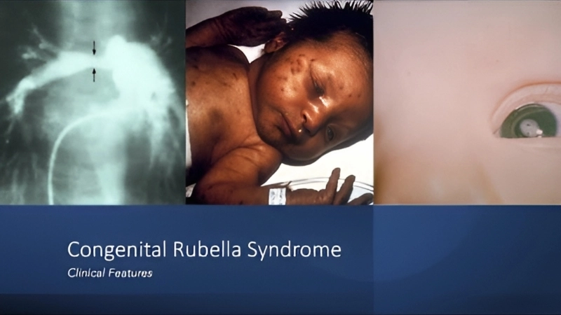 Congenital Rubella Syndrome prognosis facts