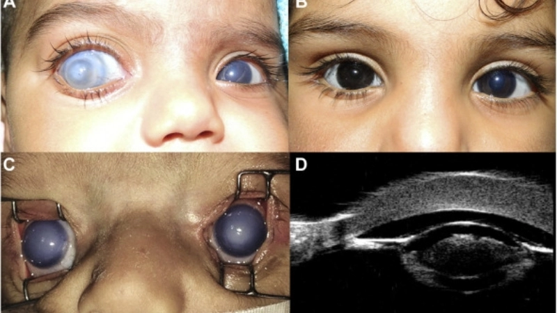 Congenital Rubella Syndrome and rubella vaccine