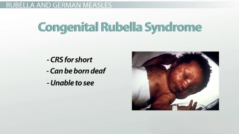 Congenital Rubella Syndrome caused by rubella virus