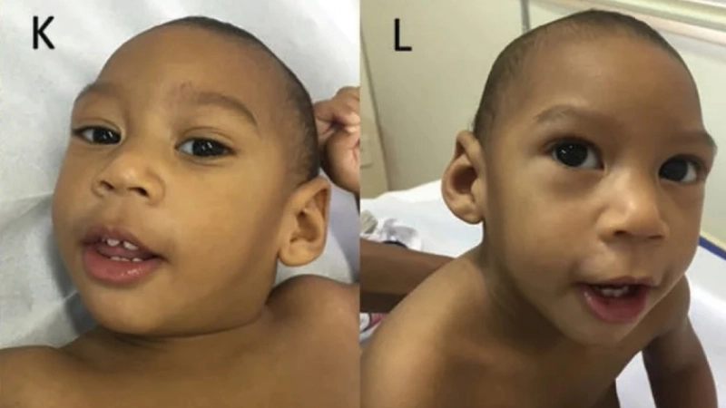 Congenital Zika Syndrome options in Zika treatment