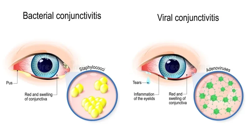 A close-up displaying common pink eye symptoms