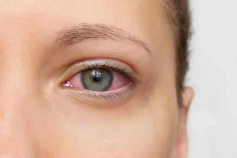 Timeline showing how long does pink eye last
