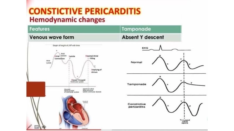 Constrictive pericarditis vs restrictive cardiomyopathy key differences