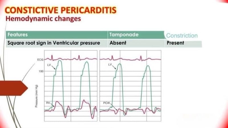 Chronic constrictive pericarditis long standing pericardial thickening