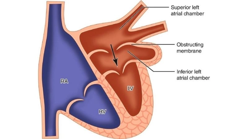Cor triatriatum sinister rare congenital atrial malformation