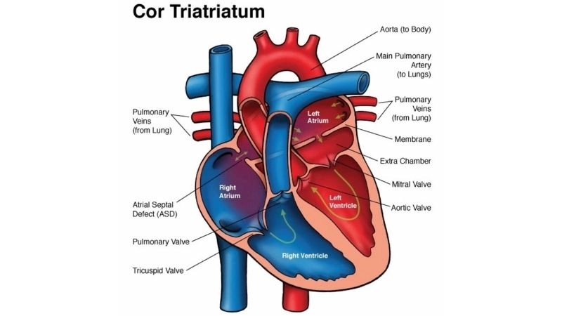 Cor triatriatum dextrum uncommon right atrial heart defect